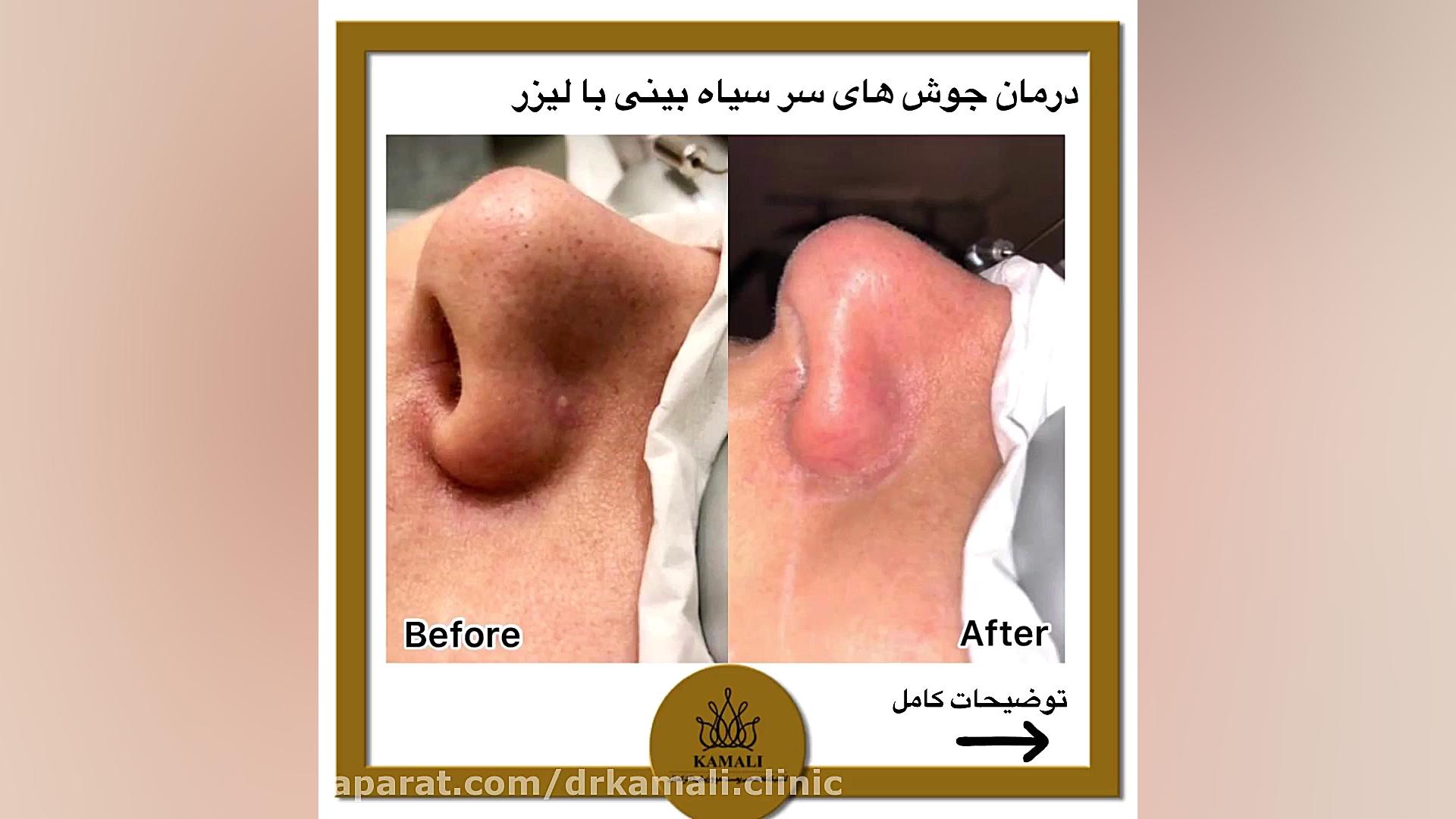 درمان جوش سر سیاه بینی با لیزر الیت پلاس در کلینیک تخصصی دکتر کمالی پروتز سینه