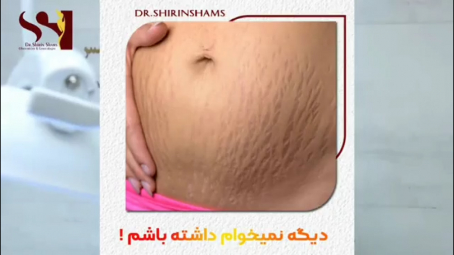 معرفی تکنیک جدید اندو آر اف برای رفع ترک های پوستی دکتر شیرین شمس جراح و متخصص زنان و زایمان