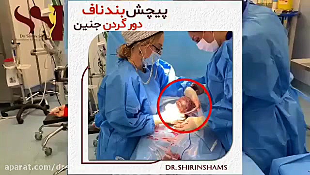 فیلم زایمان سزارین موفق با وجود پیچیدن دو دور بند ناف دور گردن نوزاد دکتر شیرین شمس جراح و متخصص زنان و زایمان