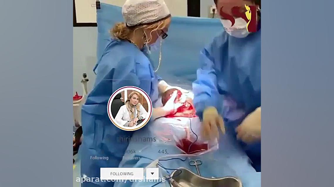 فیلم زایمان سزارین در اتاق عمل دکتر شیرین شمس جراح و متخصص زنان و زایمان