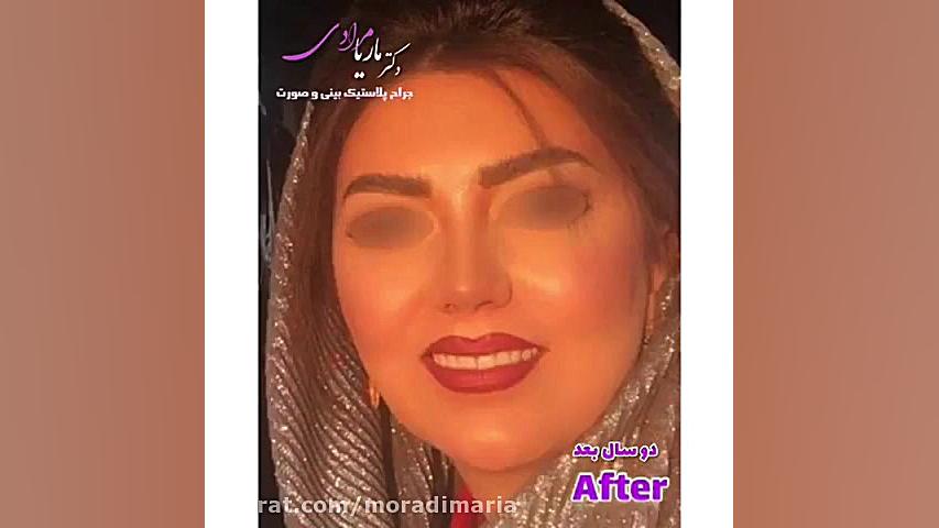 جراحي بيني توسط دكتر ماريا مرادي،بورد تخصصي جراحي گوش،حلق و بيني ماموپلاستی
