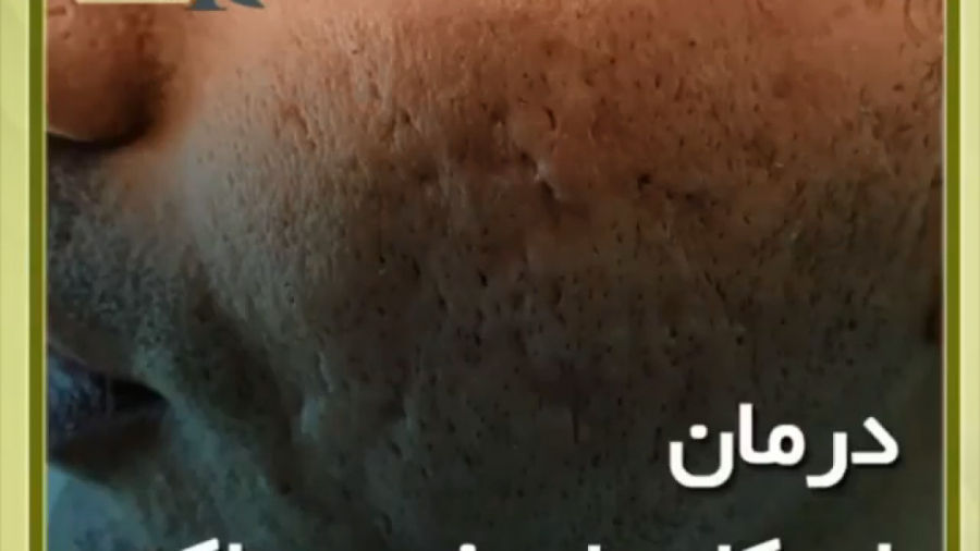 درمان اسکار شدید آکنه دکتر ایمان روغنی جراح و متخصص پوست و مو