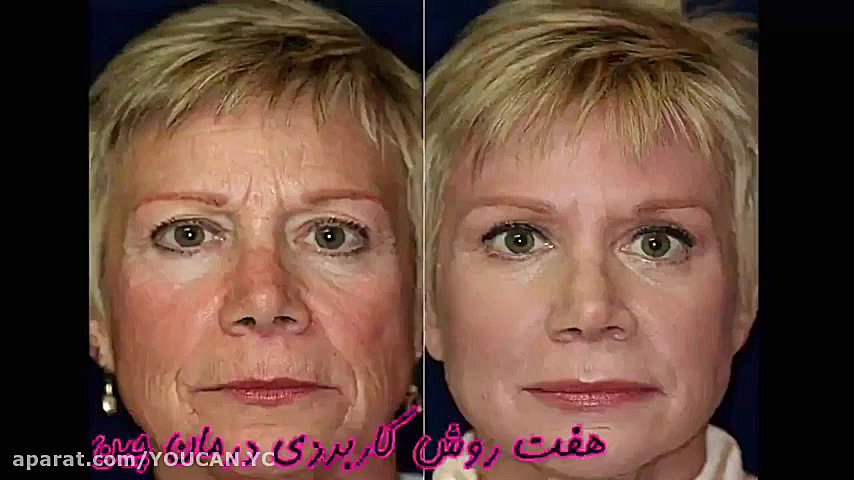 چین و چروک پوست / پیشگیری و درمان موثر برای تمامی سنین برداشتن توده