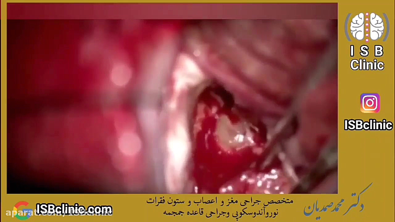 تومور داخل بطنی لیفت ابرو