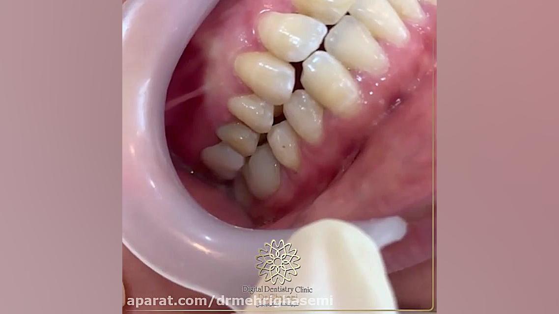 نجات یک دندان | کلینیک دندانپزشکی دیجیتال دکتر مهری قاسمی مرکز دندانپزشکی دیجیتال دکتر مهری قاسمی