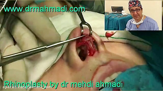 عمل زیبایی بینی(rhinoplasty)توسط متخصص گوش وحلق بینی32 دکتر مهدی احمدی