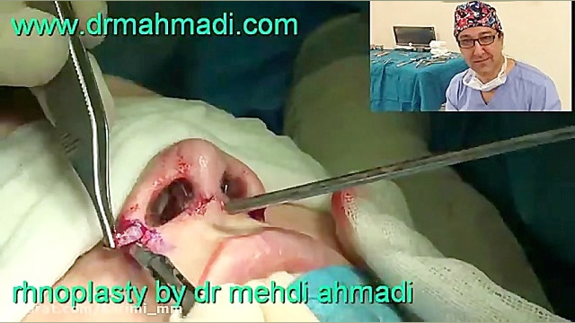 عمل جراحی زیبایی بینی متخصص گوش و حلق و بینی خوب دکتر مهدی احمدی