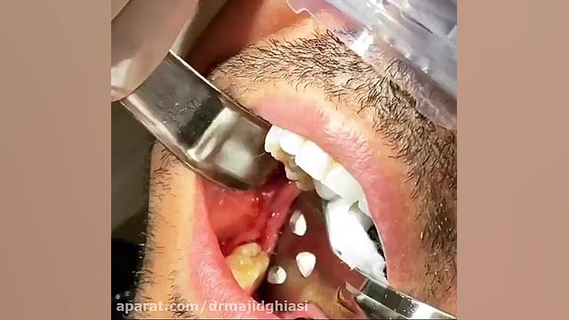 جراحی دندان عقل دکترمجیدقیاسی