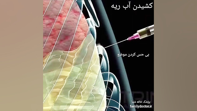 کشیدن آب ریه توراکوسنتز بیلی آیلیش