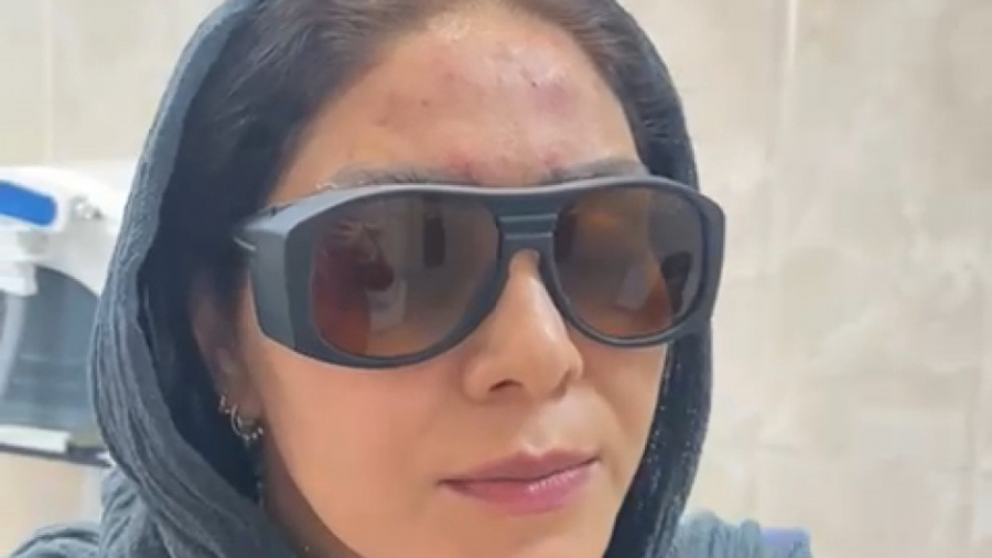 یکسال بعد از انجام یک جلسه اندولیفت لیزر جوانساز و تزریق چربی دکتر فرحناز زینعلی - متخصص پوست، مو، زیبایی زنجان