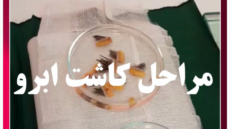 مراحل کاشت ابرو | کلینیک تخصصی کاشت موی بهبد ریژنراتیو مدیسین