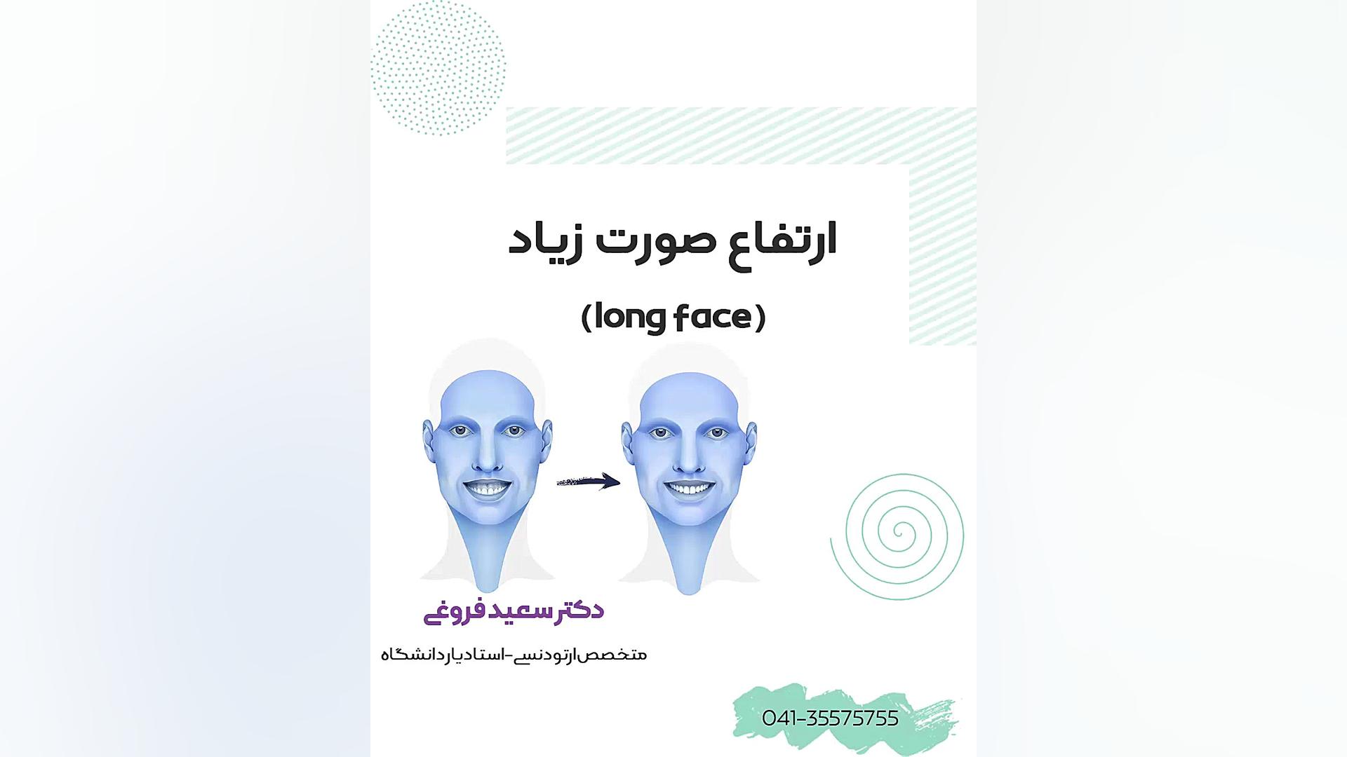 ارتفاع صورت زیاد (long face) دکتر سعید فروغی متخصص ارتودنسی