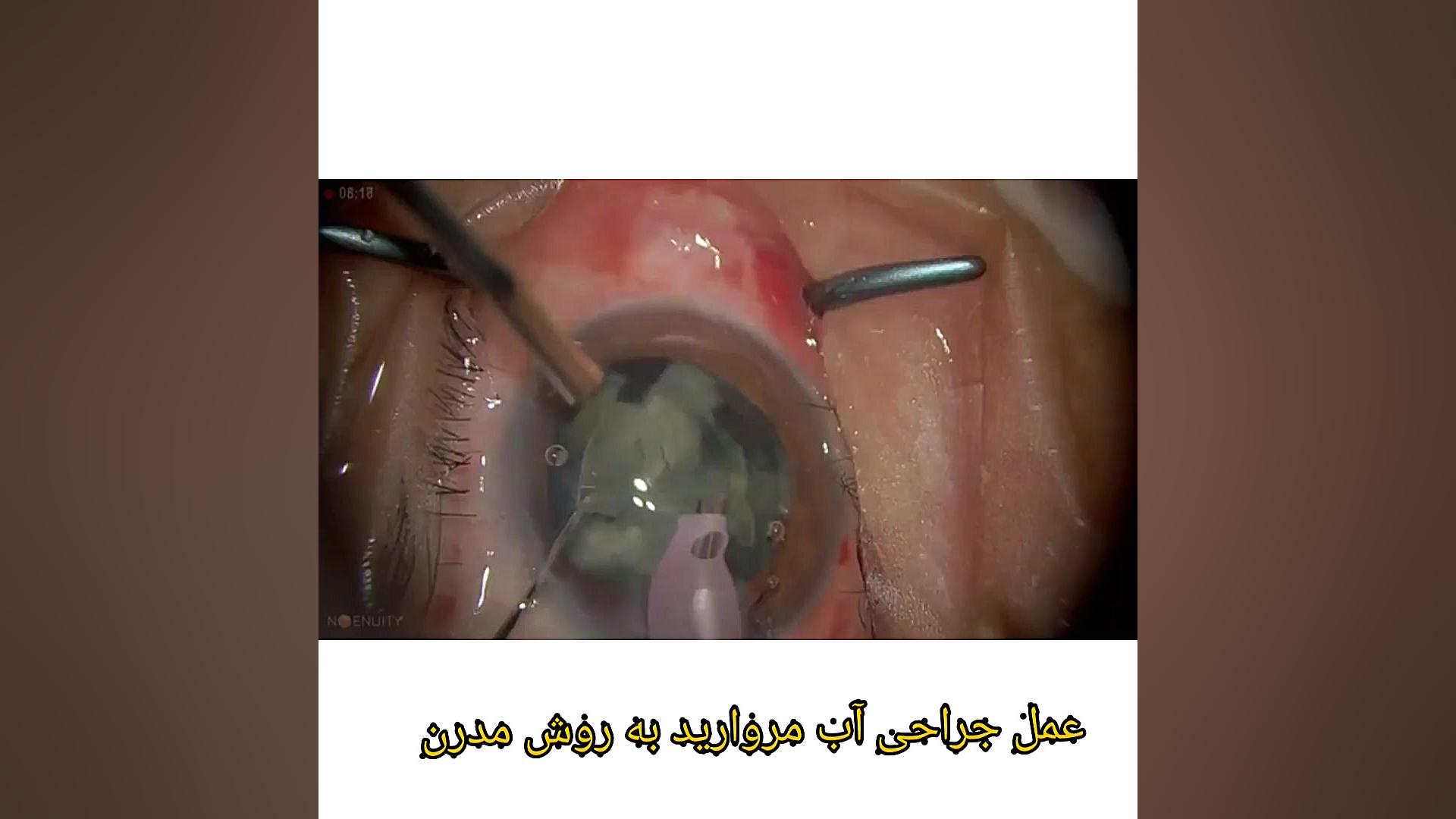 ویدیو عمل جراحی آب مروارید دکتر یاسر خاکپور چشم‌پزشک لیزر فرکشنال