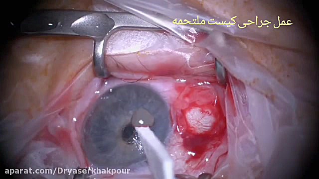 عمل جراحی کیست چشم دکتر یاسر خاکپور جراح و متخصص چشم Screening Lentiviral Vector