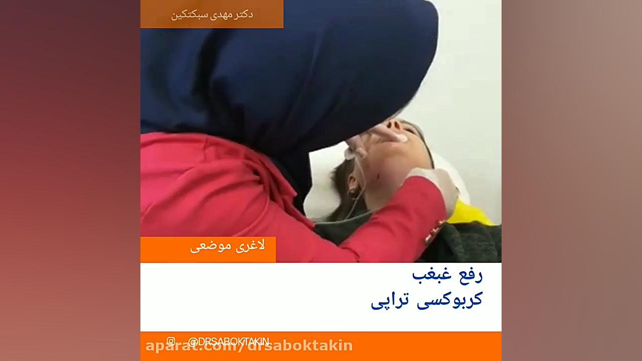 رفع غبغب بدون درد در کلینیک دکتر مهدی سبکتکین متخصص پوست اصفهان متخصص پوست اصفهان دکتر مهدی سبکتکین