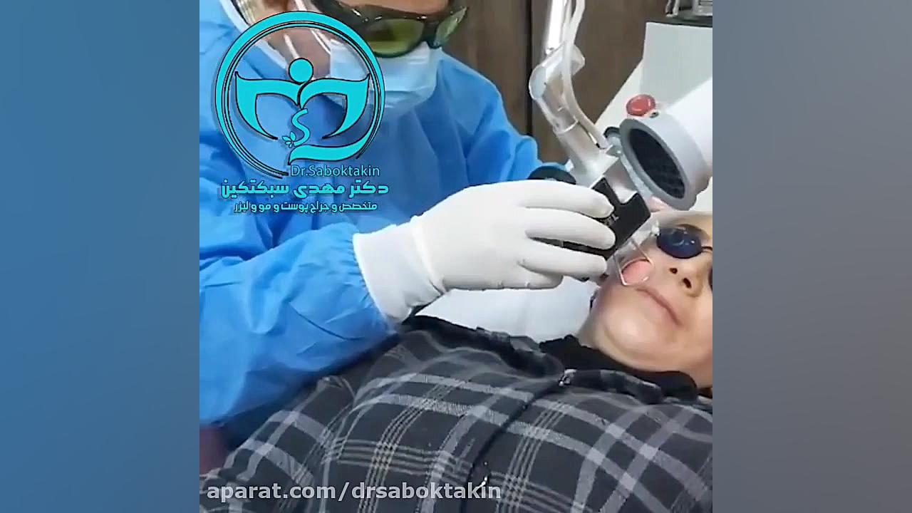 لیزر فرکشنالco2 جهت درمان جای آکنه و جوش جرمگیری