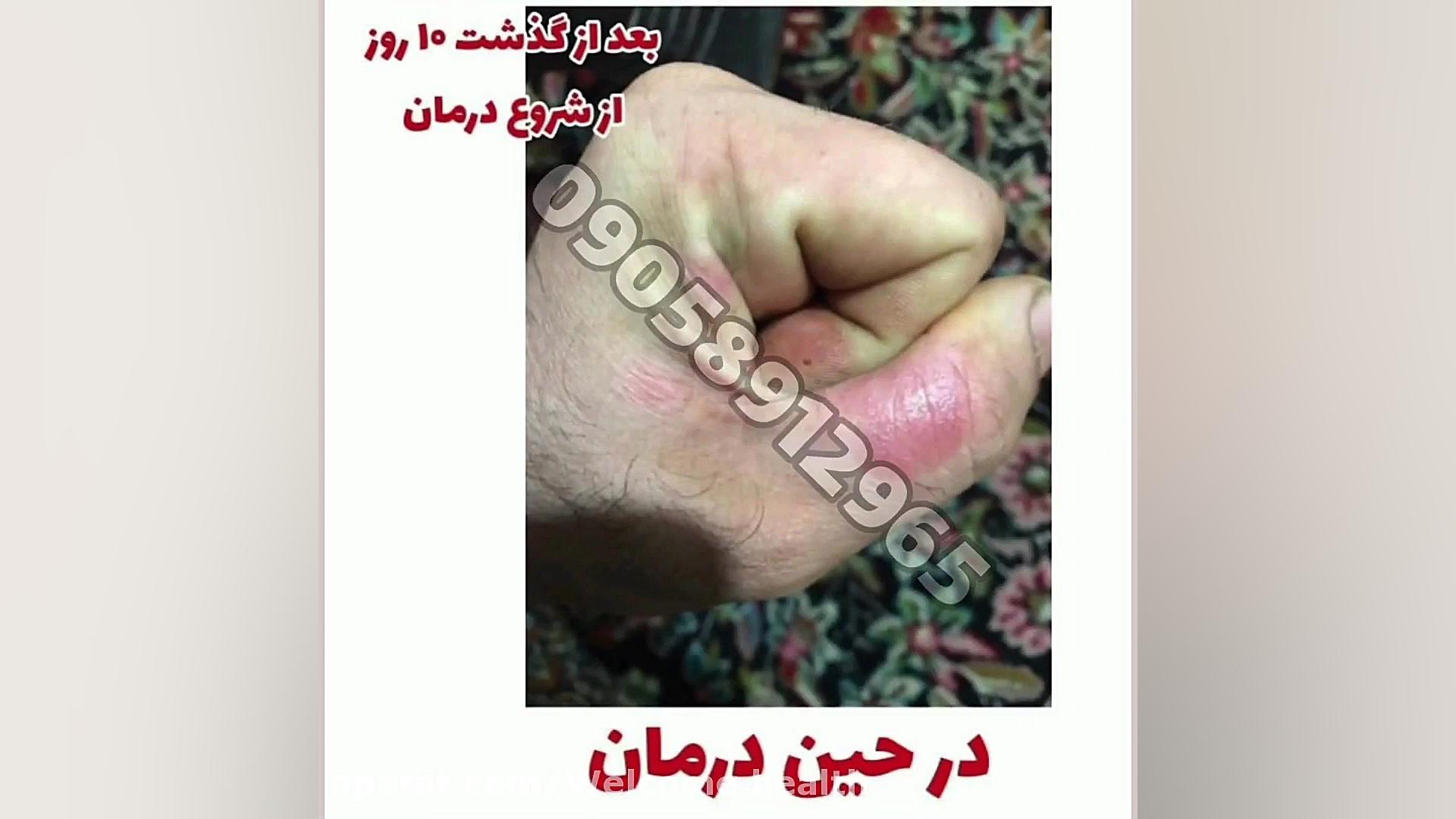 درمان بیماری پسوریازیس یا صدفک بدون کورتون لیفت ابرو