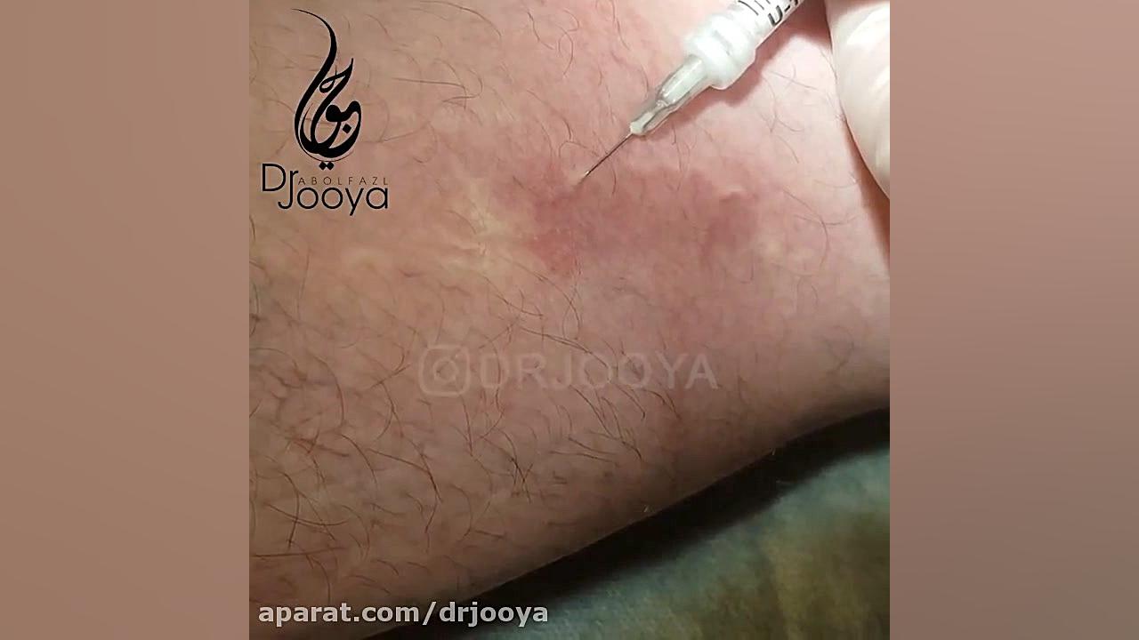 درمان واریس توسط دکتر جویا متخصص پوست اصفهان دکتر ابوالفضل جویا