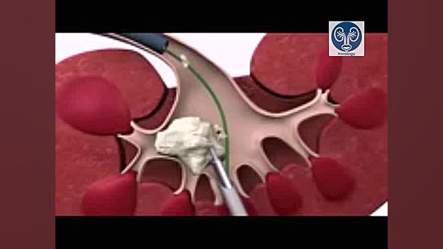 سنگ شکنی کلیه به روش PCNL زاویه سازی صورت