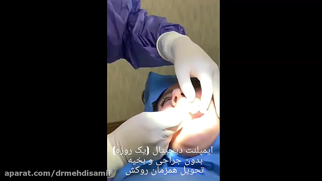 ایمپلنت دیجیتال ( فوری) - مراحل انجام ایمپلنت دیجیتال در یک روز کانال رسمی دکتر مهدی سمیعی