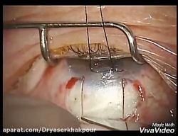 فیلم عمل جراحی آب سیاه دکتر یاسر خاکپور جراح و متخصص چشم