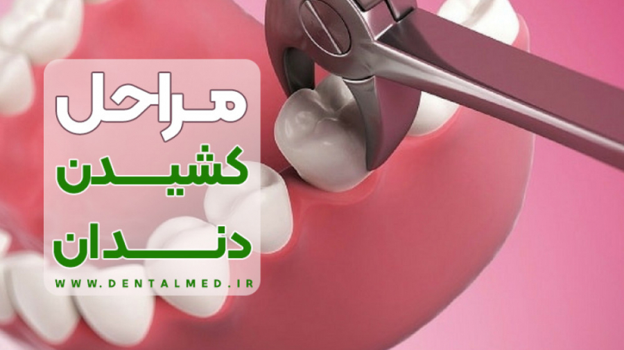 مراحل کشیدن دندان همراه با معرفی ابزارهای دندانپزشکی برای دستیار دندانپزشک درمان ریزش مو