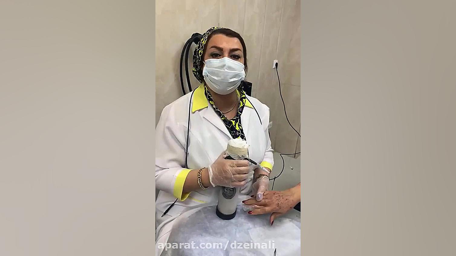 رفع لکهای لنتیگوی پیری و آفتابی با کرایوتراپی دکتر فرحناز زینعلی - متخصص پوست، مو، زیبایی زنجان