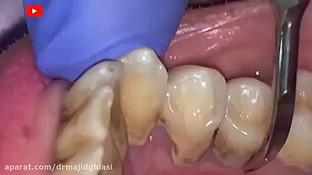 جرمگیری دندان زیبایی دکترمجیدقیاسی