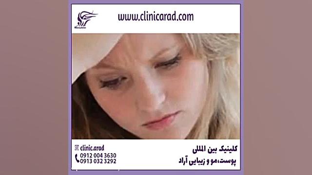 روش های درمان لک صورت در کلینیک بین المللی آراد اصفهان لیزر موهای زائد