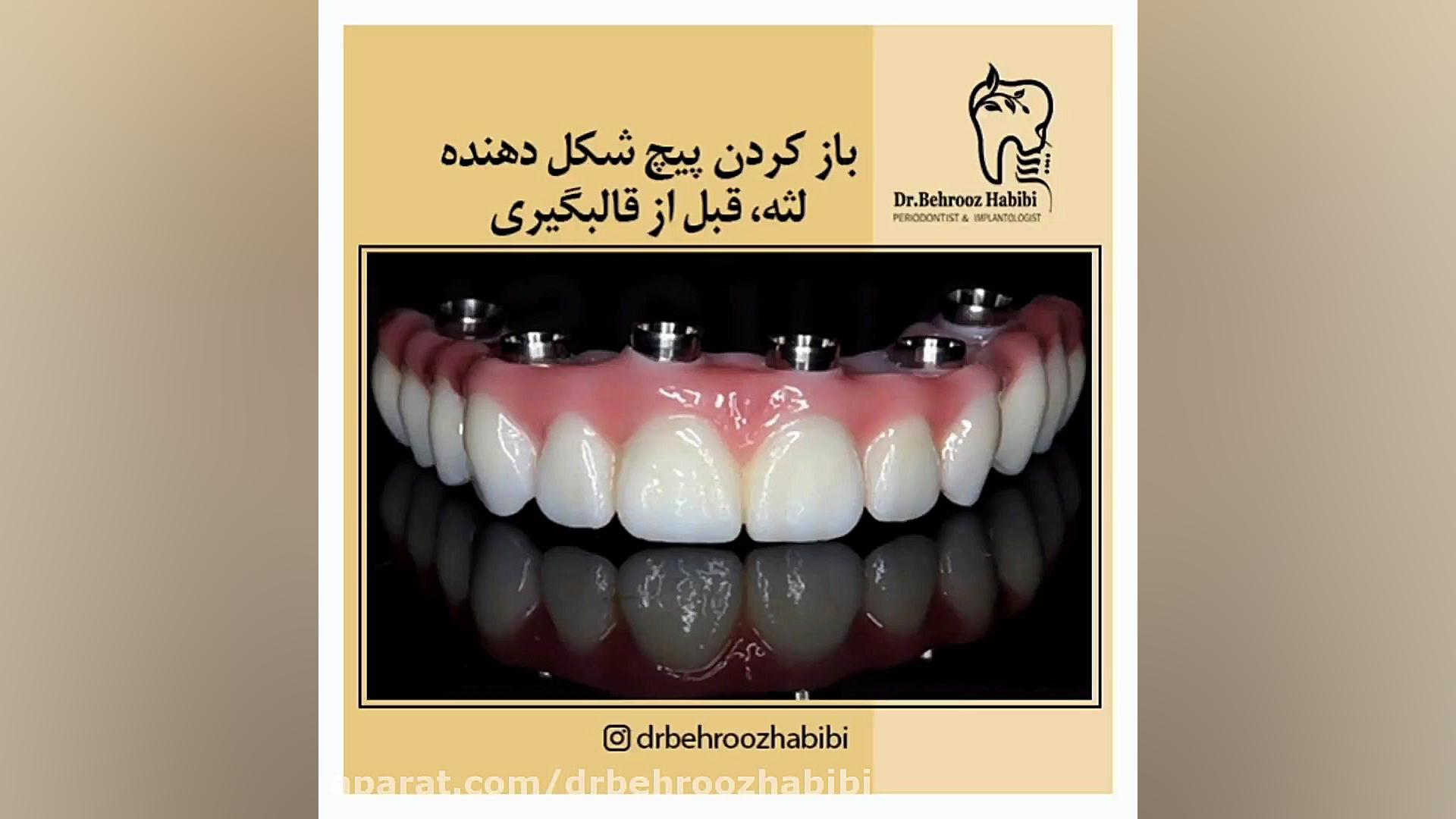 مرحله باز کردن پیچ شکل دهنده لثه، قبل از قالبگیری دکتر بهروز حبیبی
