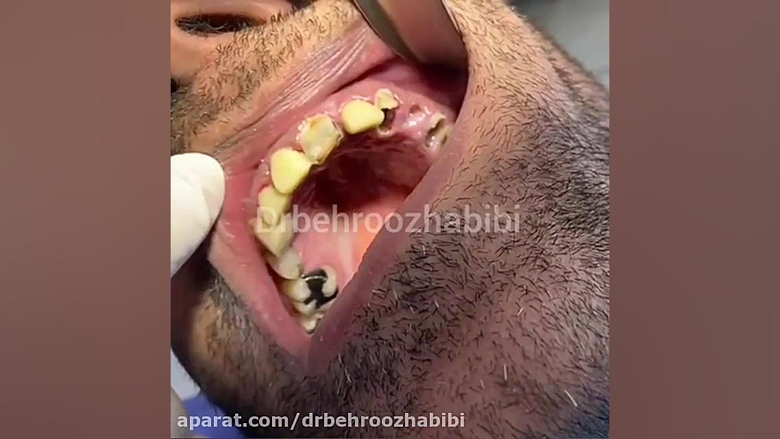 پوسیدگی بیش از حد دندان ها دکتر بهروز حبیبی