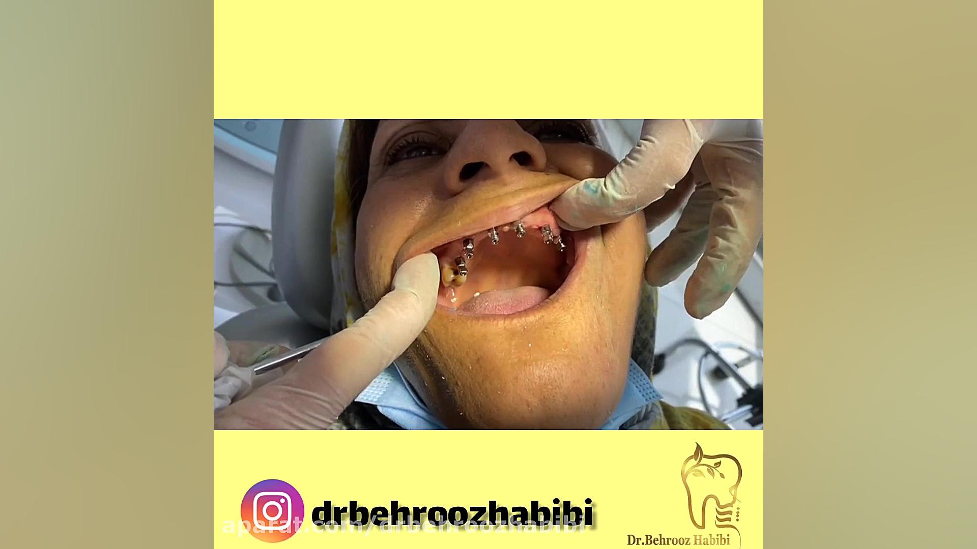 پیچ های قالب گیری دکتر بهروز حبیبی