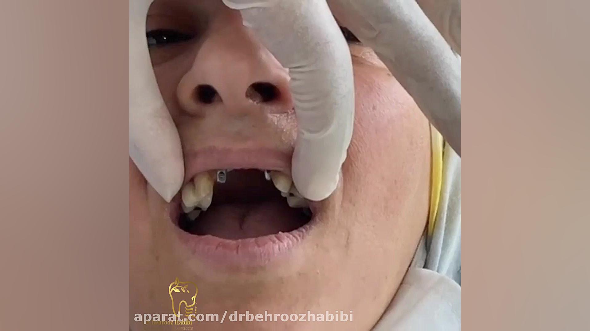 تحویل روکش ایمپلنت واسه مراجعه کننده عزیزمون دکتر بهروز حبیبی