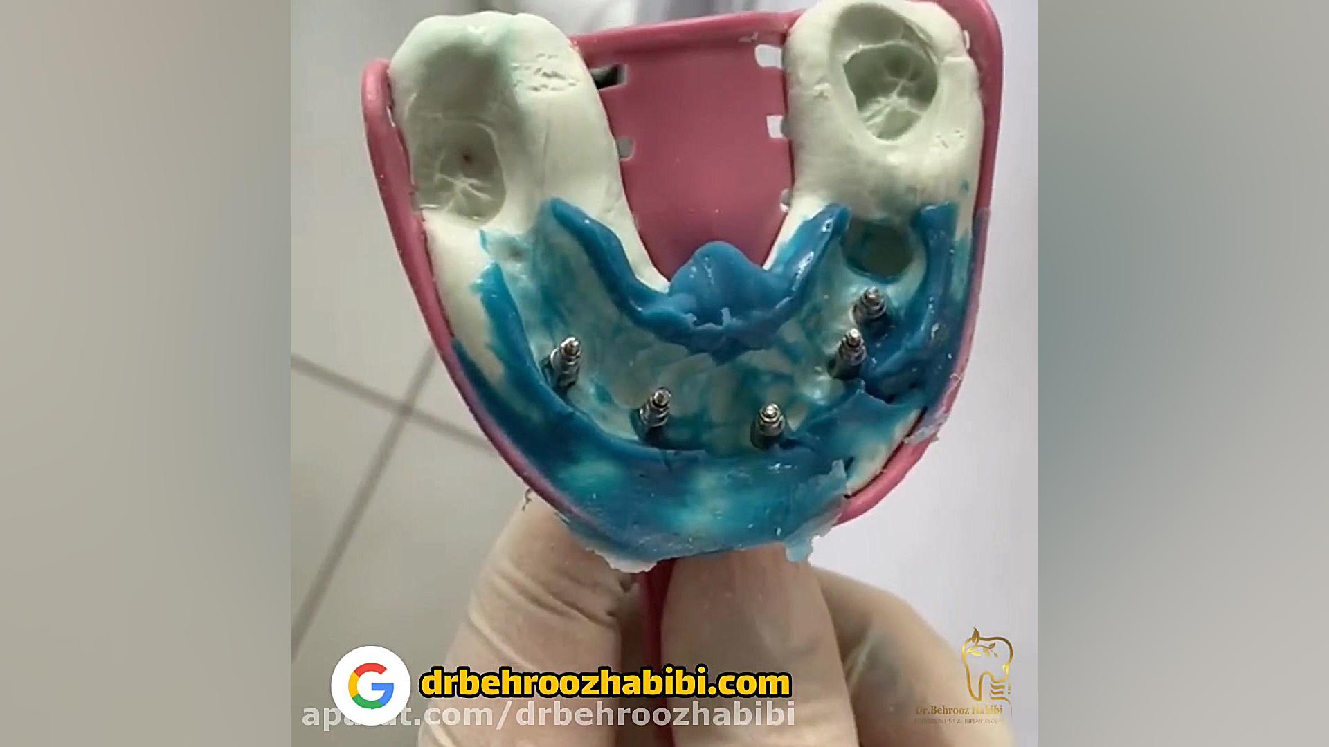مرحله قالب گیری ایمپلنت دکتر بهروز حبیبی