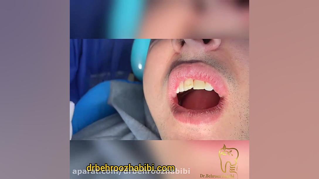 مرحله تحویل روکش ایمپلنت دندان دکتر بهروز حبیبی