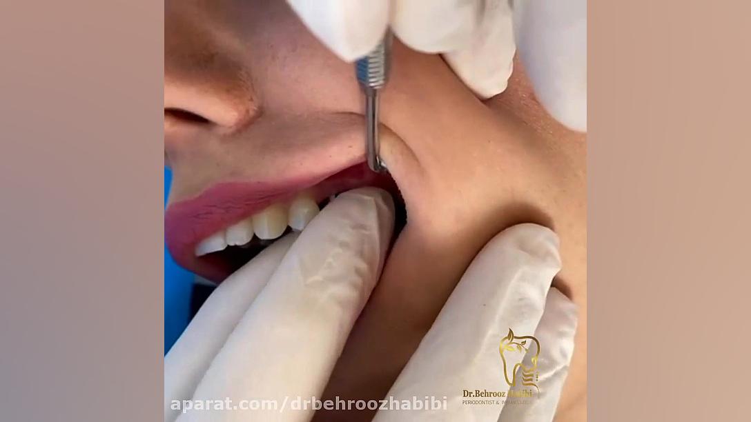 مرحله تحویل روکش دندان اتوپلاستی