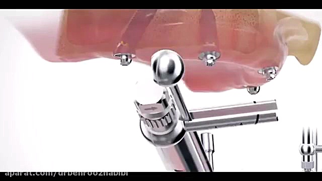 انیمیشن زیبای ایمپلنت دکتر بهروز حبیبی