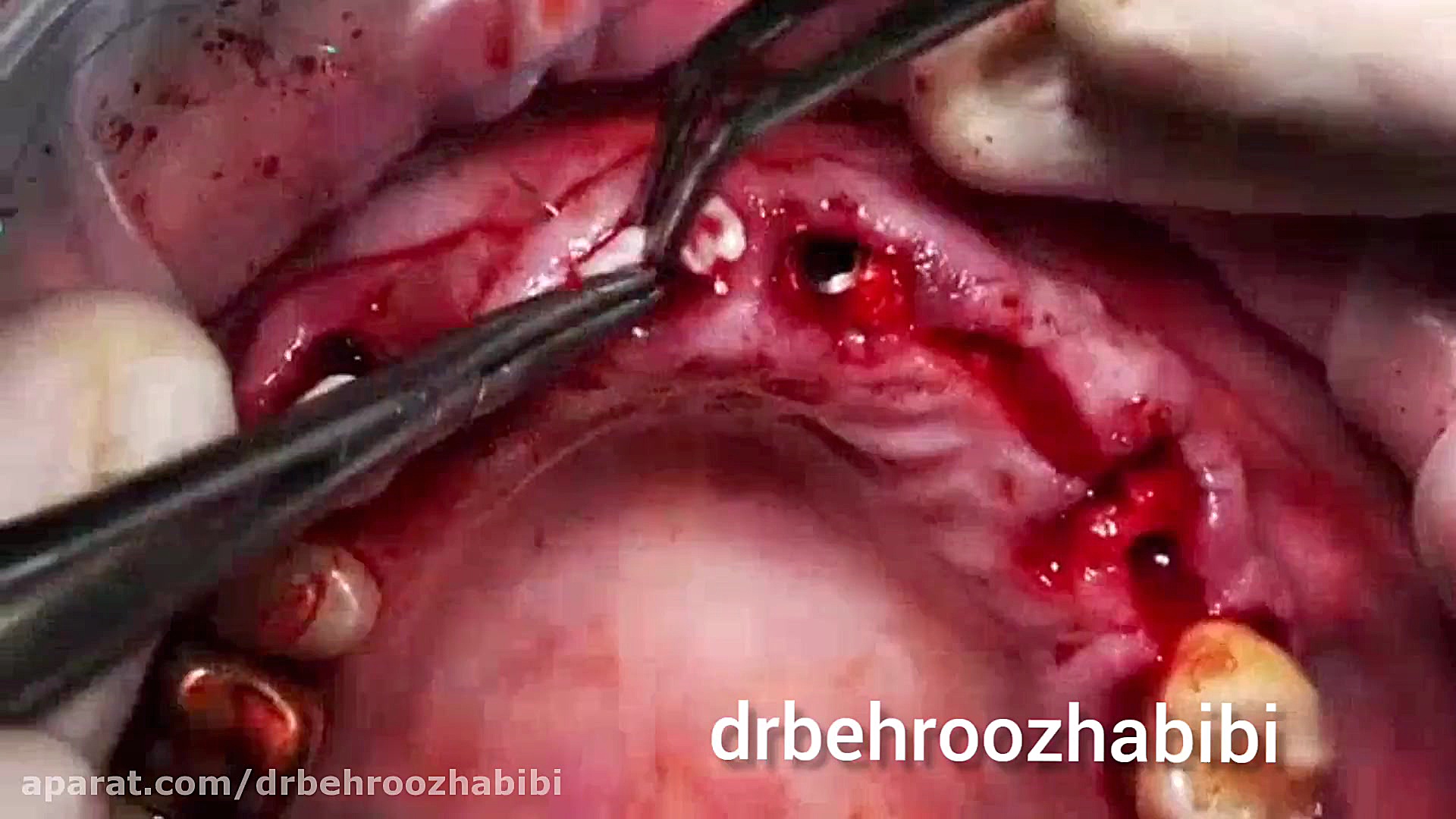 ایمپلنت دجیتال با پانچ لثه دکتر بهروز حبیبی