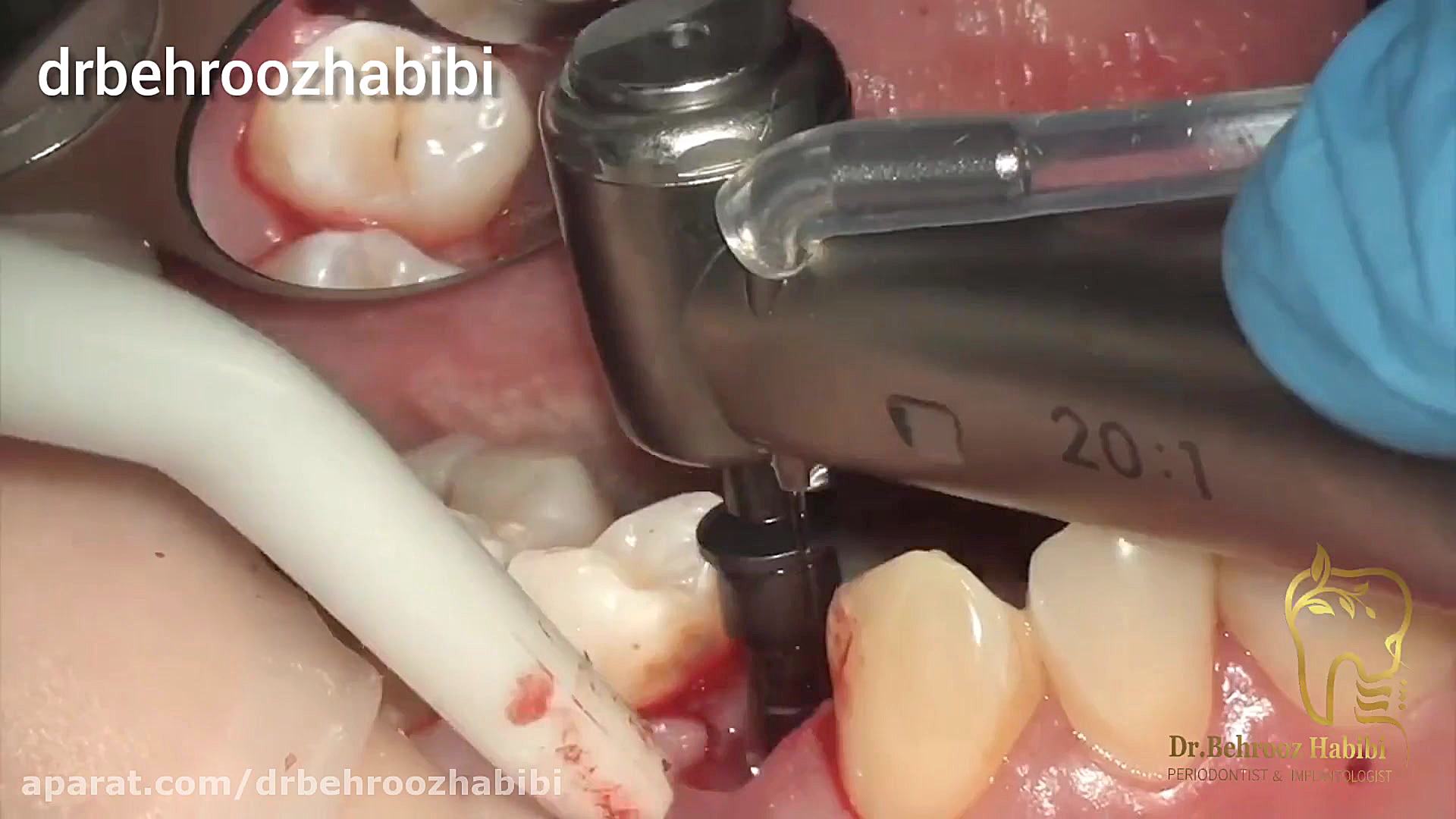 جراحی کاشت ایمپلنت همراه با پیوند لثه برای رفع گودی فک دکتر بهروز حبیبی