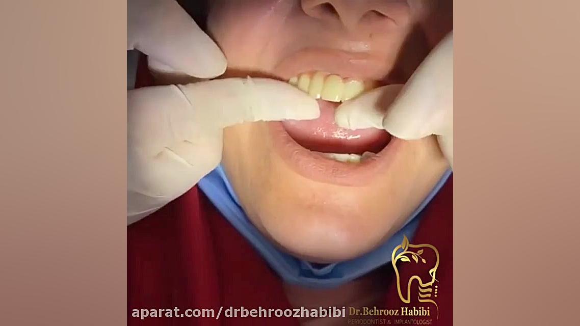 تحویل روکش مراجعه کننده غزیز با پر کردن فضای خالی لثه دکتر بهروز حبیبی