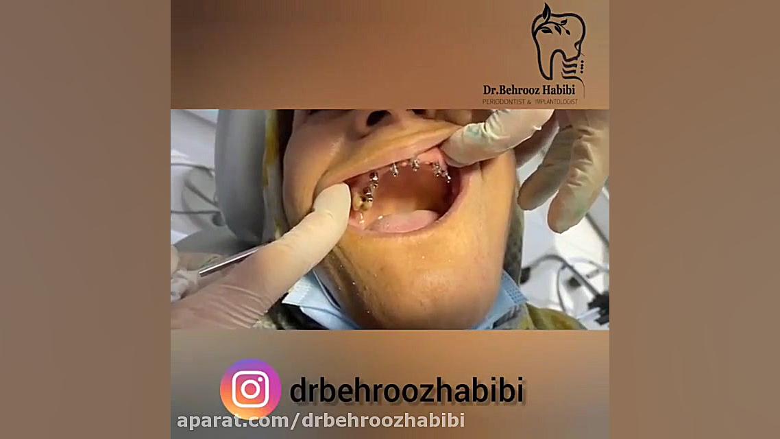پیچ های قالب گیری دکتر بهروز حبیبی