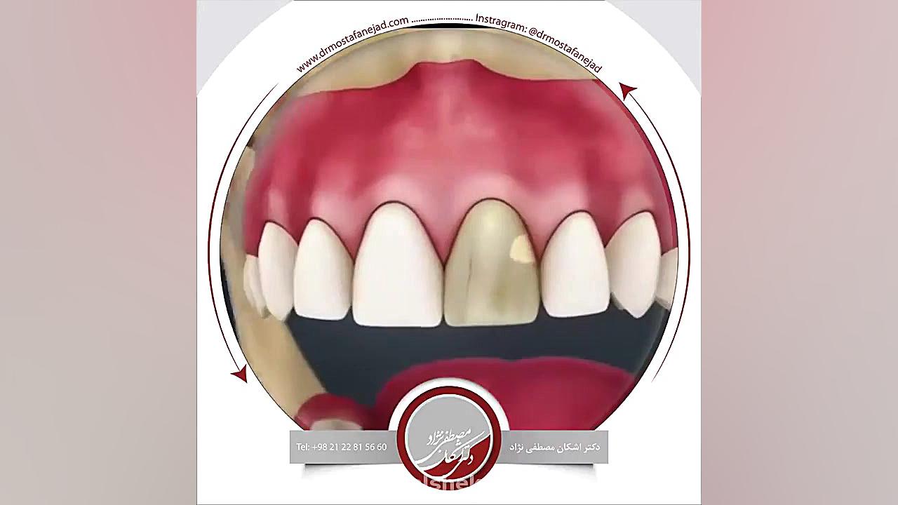 انیمیشن روکش دندان HiChIP