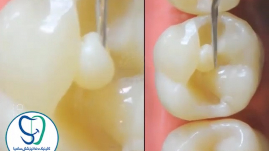 ترمیم دندان با کامپوزیت همرنگ دندان هایپرپاراتیروئیدیسم