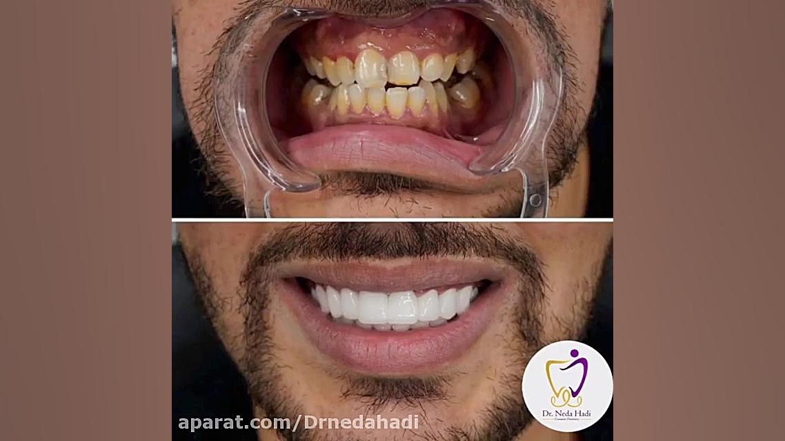 لبخند و رضايت زیباجوی عزیزمون دکتر ندا هادی-دندانپزشک زیبایی