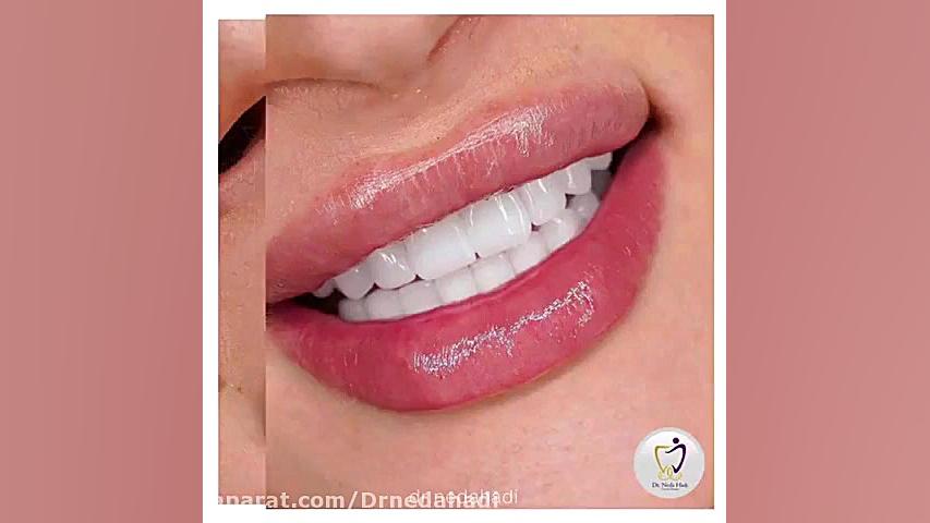 قبل و بعد از لمینت دندان مراجعه کننده عزیز دکتر ندا هادی-دندانپزشک زیبایی