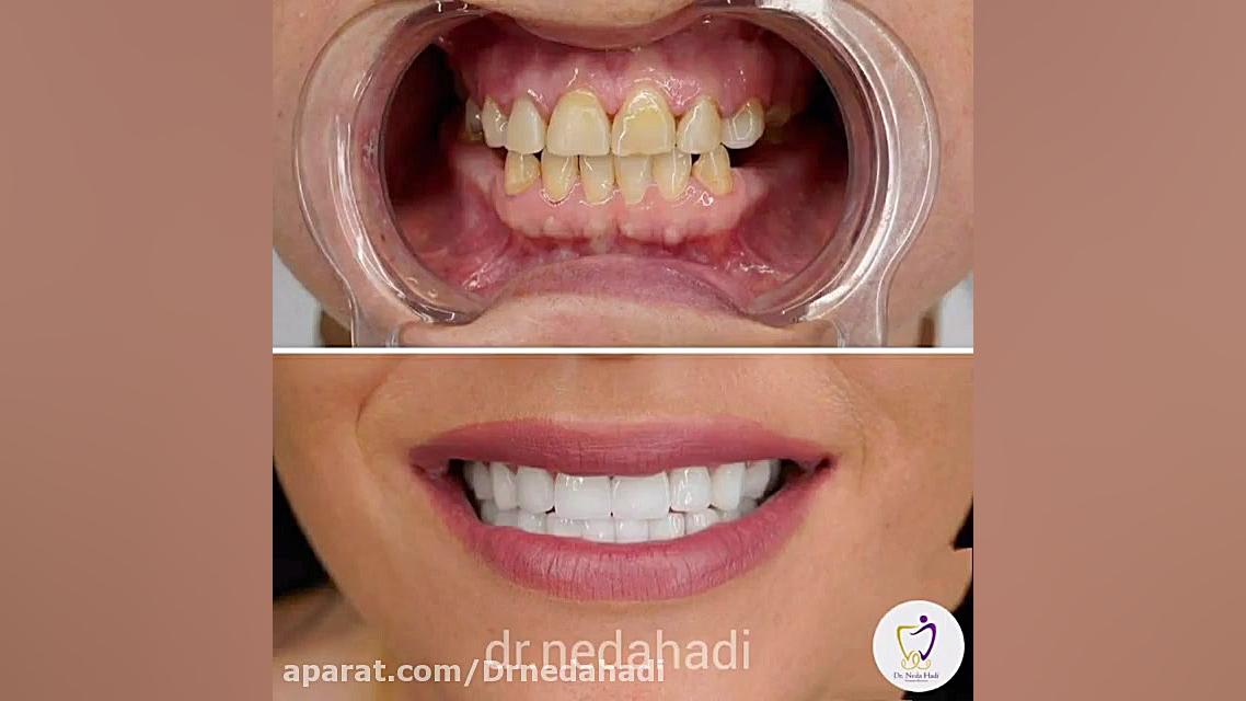 نمونه کار قبل و بعد و رضایت زیباجوی عزیز دکتر ندا هادی-دندانپزشک زیبایی