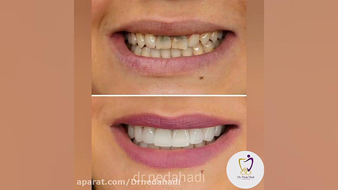 لبخند زیبای شما دکتر ندا هادی-دندانپزشک زیبایی