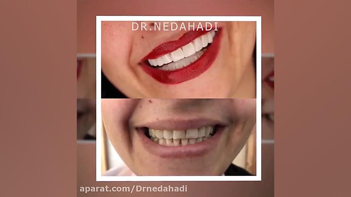 نمونه کارهای زیبایی دندان - دکتر ندا هادی آزمایش بلوغ ریوی جنین