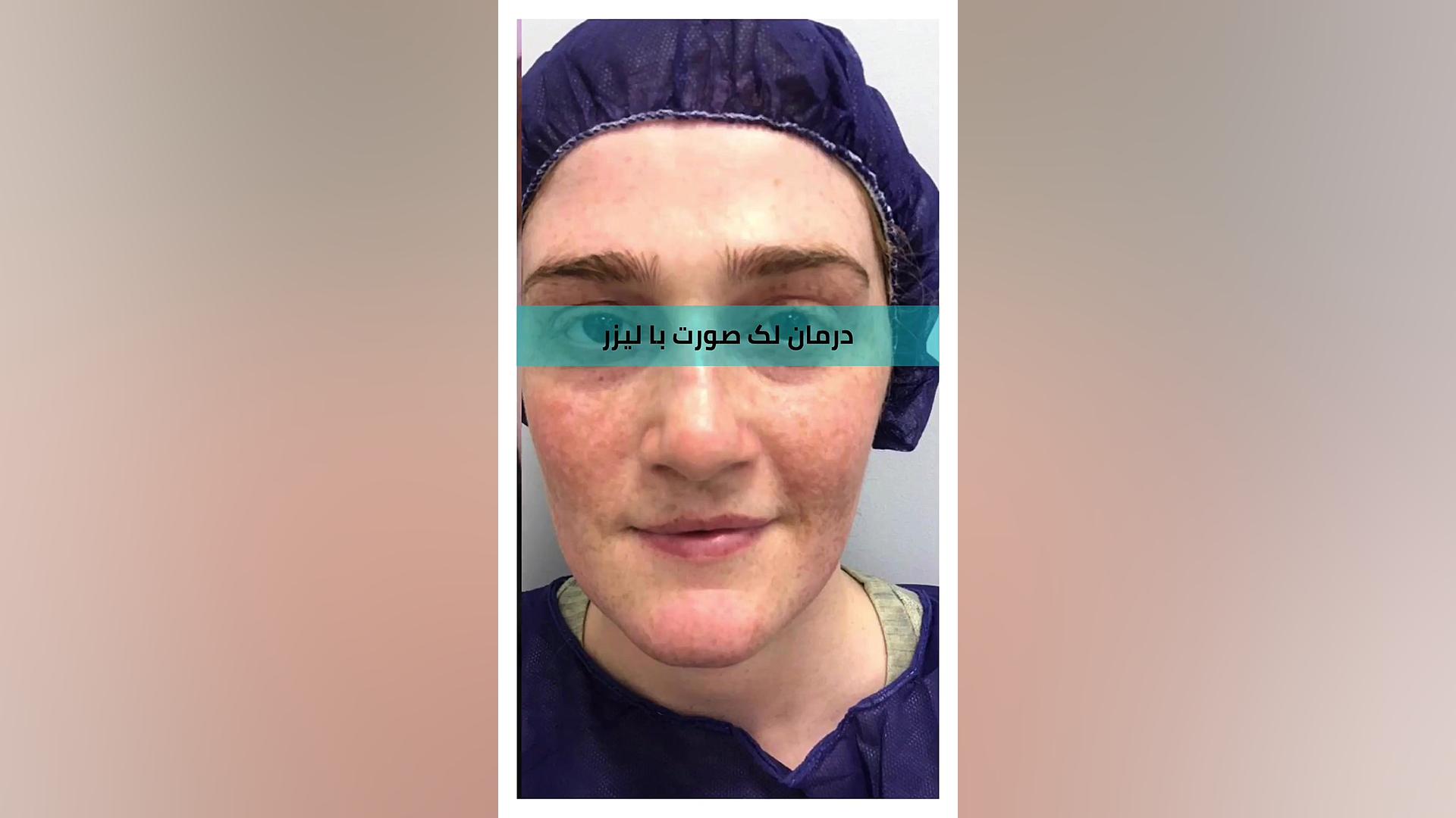 درمان لک صورت با لیزر آر اف فرکشنال