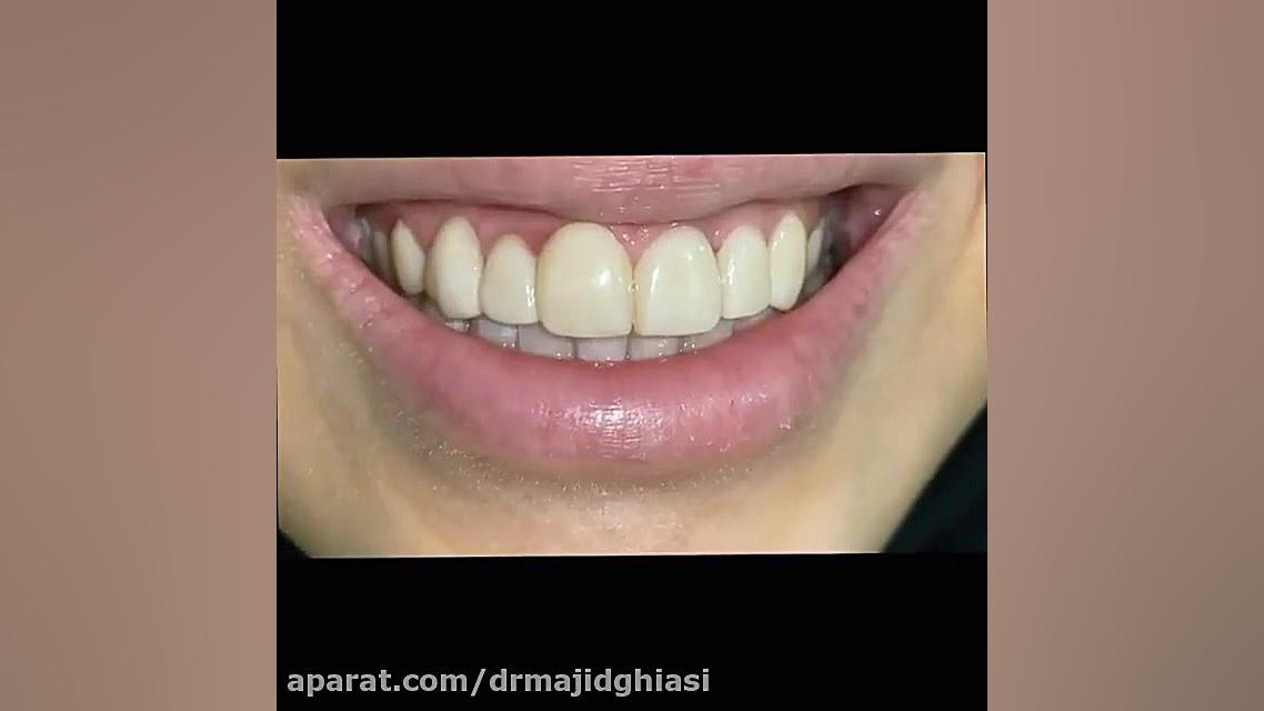 اصلاح طرح لبخند MRCP